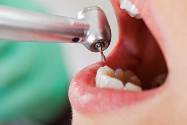 Best Emergency Dental Care for Abscessed Tooth in Bee Cave, TX